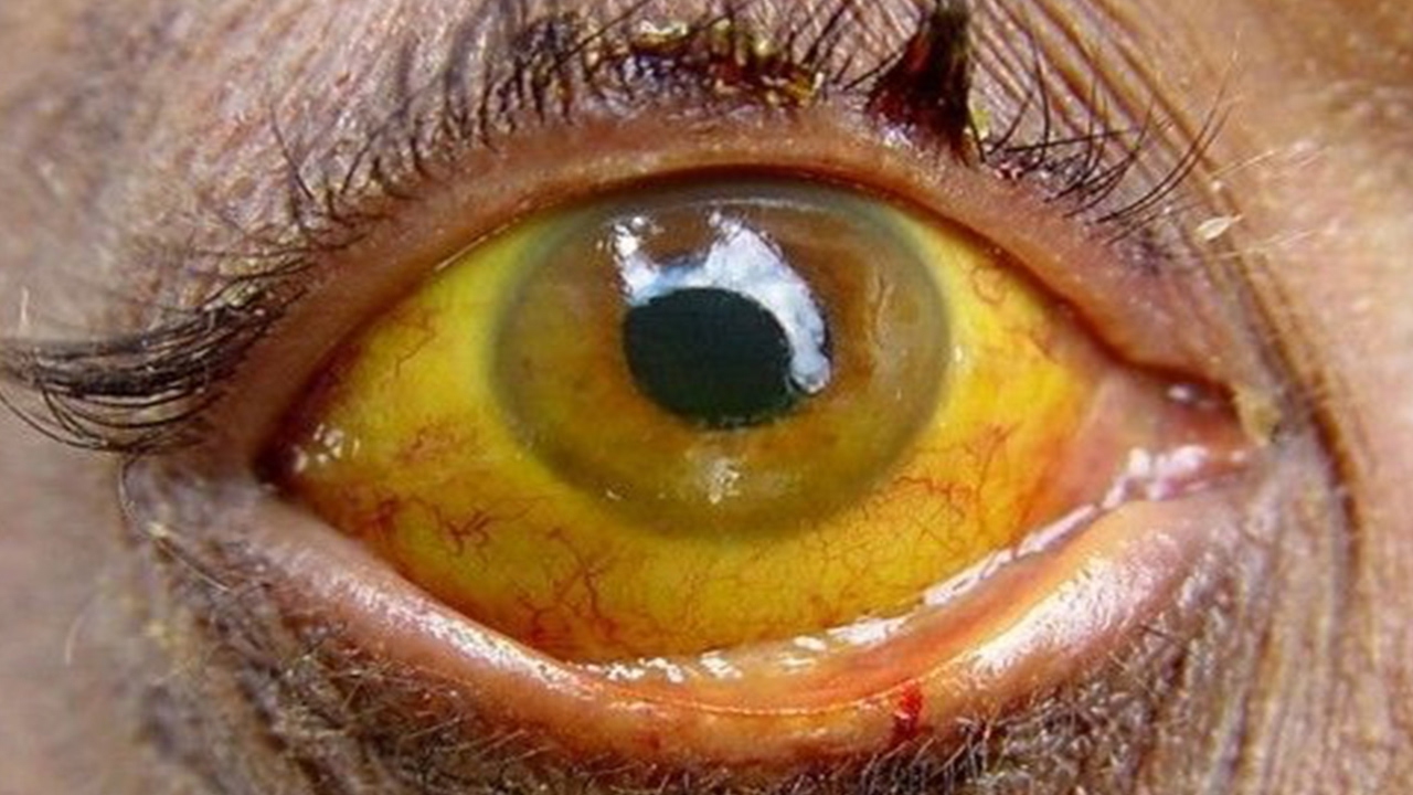 Stop sunbathing babies with jaundice Paediatric Society