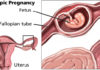 abortion