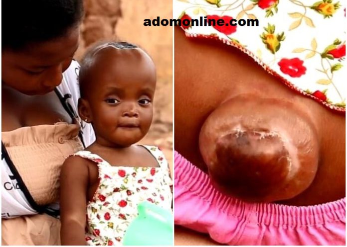 The 11-month old baby has abnormal large head and growth at the back.