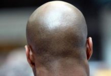 Men: How to spot the early warning signs of baldness bald men