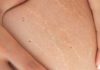 stretch marks