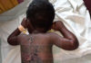Father beats 3-year-old son with naked wire child abuse