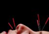 acupuncture