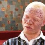 Albinos in Mozambique ‘still going missing’