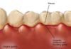 gingivitis teeth