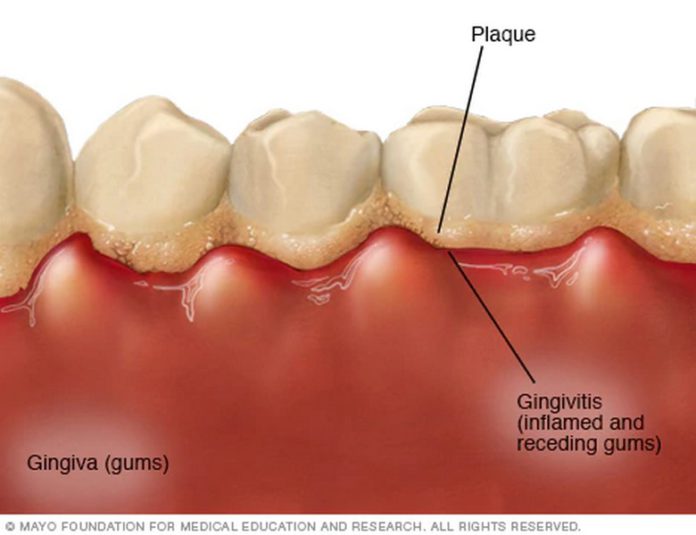gingivitis teeth