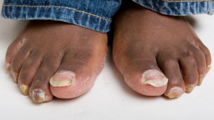 4 home remedies to treating toenail fungus