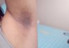 Dark underarm