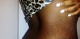 stretch marks