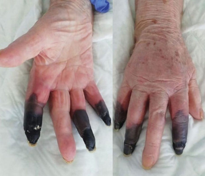 Covid-19 symptoms: Patient's fingers turn black [Photos] 52