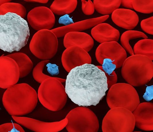 14 days in ICU: Sickle cell is more than a disease we remember in September