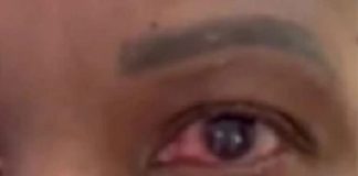 eye