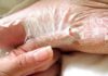 Peeling skin