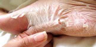 Peeling skin