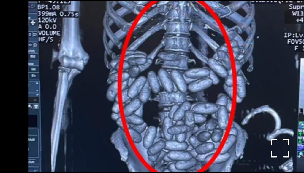 Beads of cocaine in man's stomach
