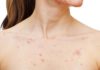chest acne