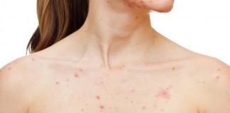 chest acne