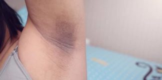 Dark underarm