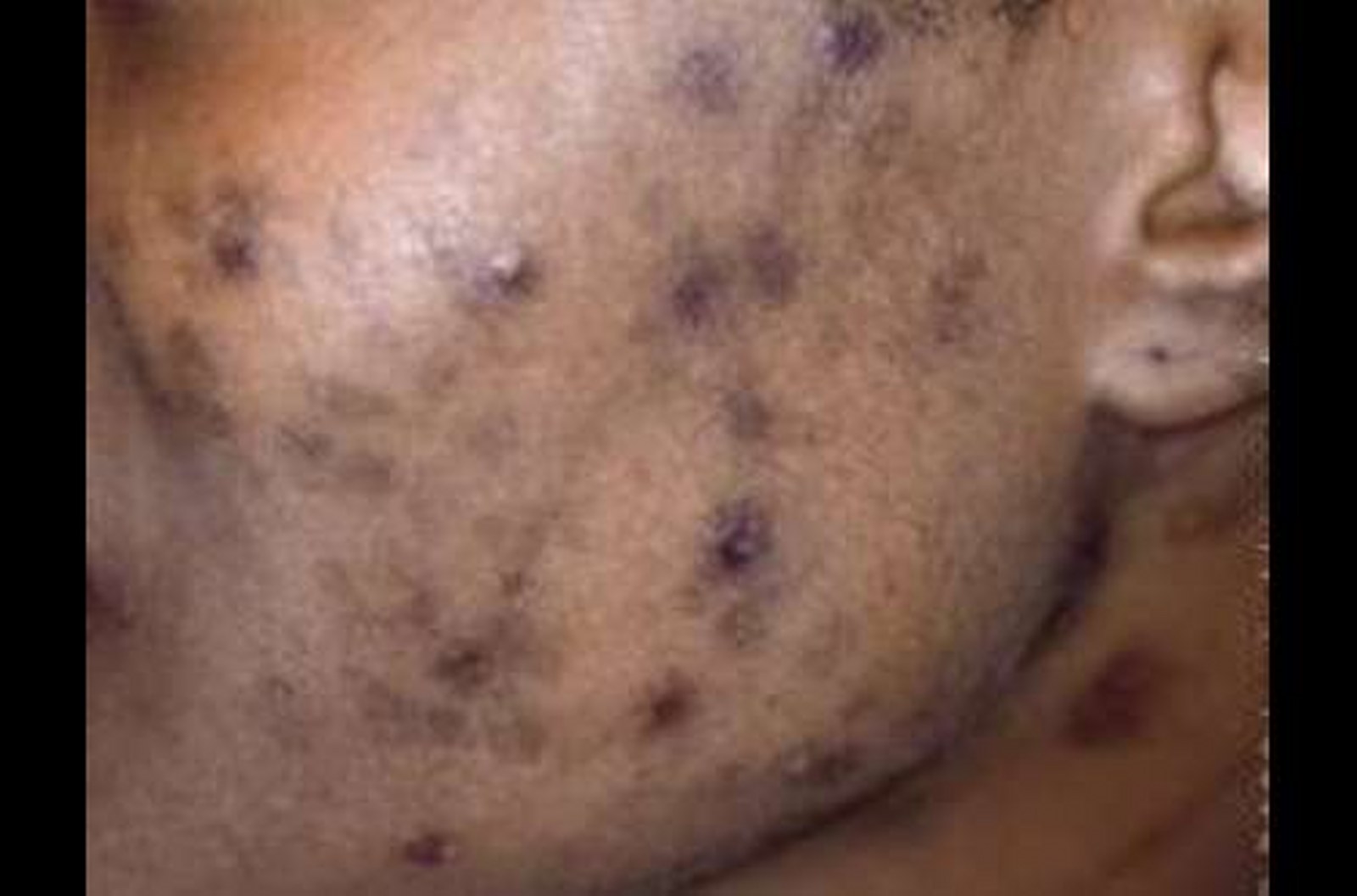 Five natural ways to remove black spots at home