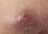 occur in areas where hair and sweat coexist [Pulse Nigeria]