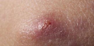 occur in areas where hair and sweat coexist [Pulse Nigeria]