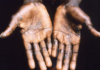 Monkeypox symptoms include an itchy rash and lesions mainly on hands and feet