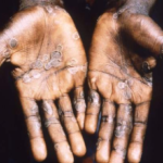 Monkeypox symptoms include an itchy rash and lesions mainly on hands and feet