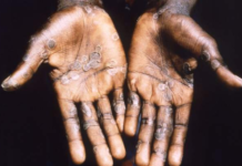 Monkeypox symptoms include an itchy rash and lesions mainly on hands and feet