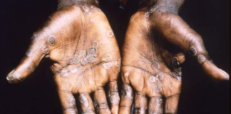Monkeypox symptoms include an itchy rash and lesions mainly on hands and feet