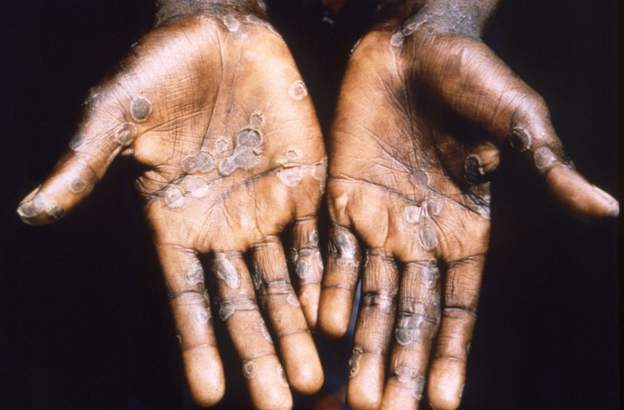 Monkeypox symptoms include an itchy rash and lesions mainly on hands and feet