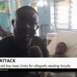 Boy loses limbs after teacher poured acid on him for allegedly stealing his bicycle