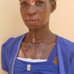 Man jailed for bathing lover with acid over divorce