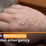 WHO urges reduction in number of sexual partners as monkeypox surges