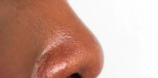 Treating oily nose