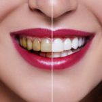 Teeth whitening: Exploring the craze to have brighter smiles teeth