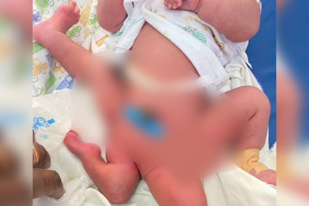 KATH surgeons perform complex limb malformation operation