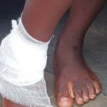 STRAY DOG BITE