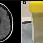 Live worm found in woman’s brain during surgery
