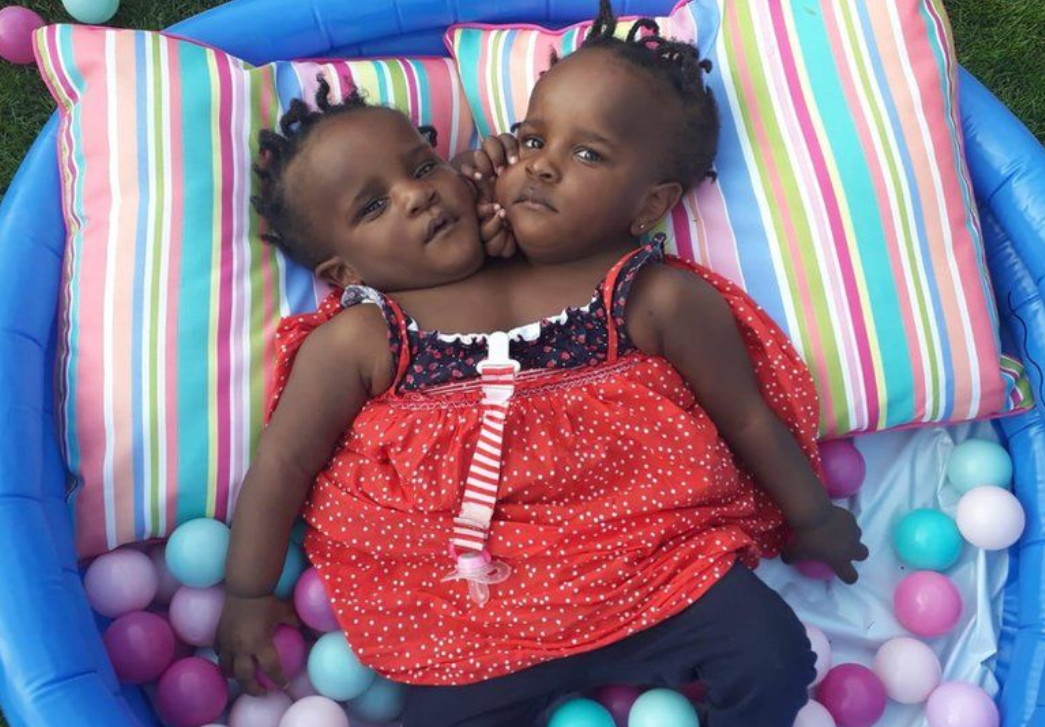 Miracle Twins Conjoined siblings given days to live beat the odds