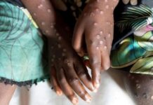 37 new Mpox cases recorded; total hits 409 Monkeypox
