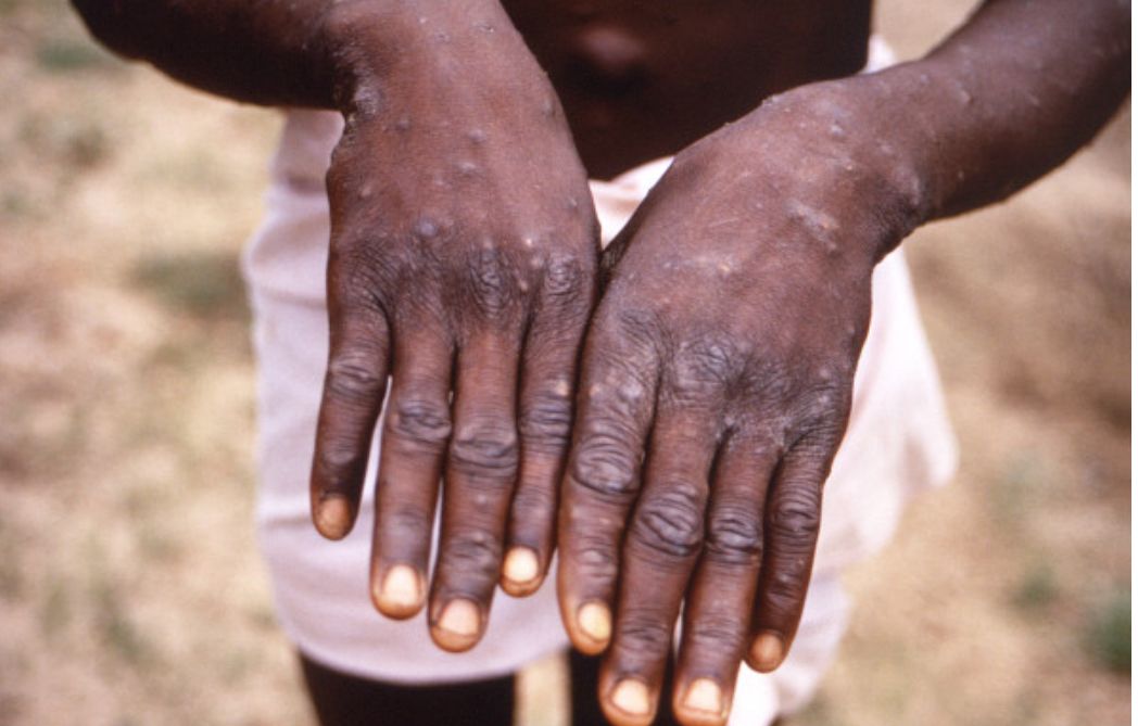 Mpox concerns heighten as Ashanti Region tests 10 suspected cases