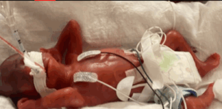 128,000 babies born preterm in Ghana annually – WHO