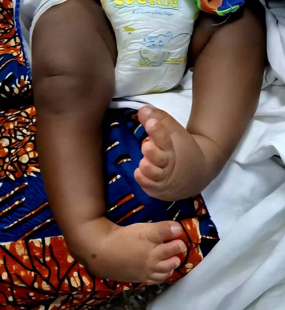 Over 9,000 Ghanaian children receive free life-changing treatment for clubfoot as experts push for early detection