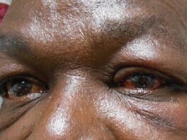 Apollo outbreak hits Sefwi Wiawso; health authorities issue public health alert