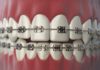 Braces beyond treatment: Gen Z’s fashion craze and the hidden dental risks