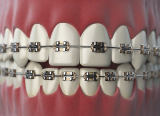 Braces beyond treatment: Gen Z’s fashion craze and the hidden dental risks