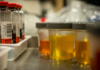 Urine test can spot more than nine in 10 bladder cancers