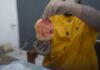 Kumasi Hospital removes 880-gram bladder stone in rare surgical case