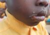 Mafi Kope residents appeal for urgent medical intervention over illnesses affecting children, adults